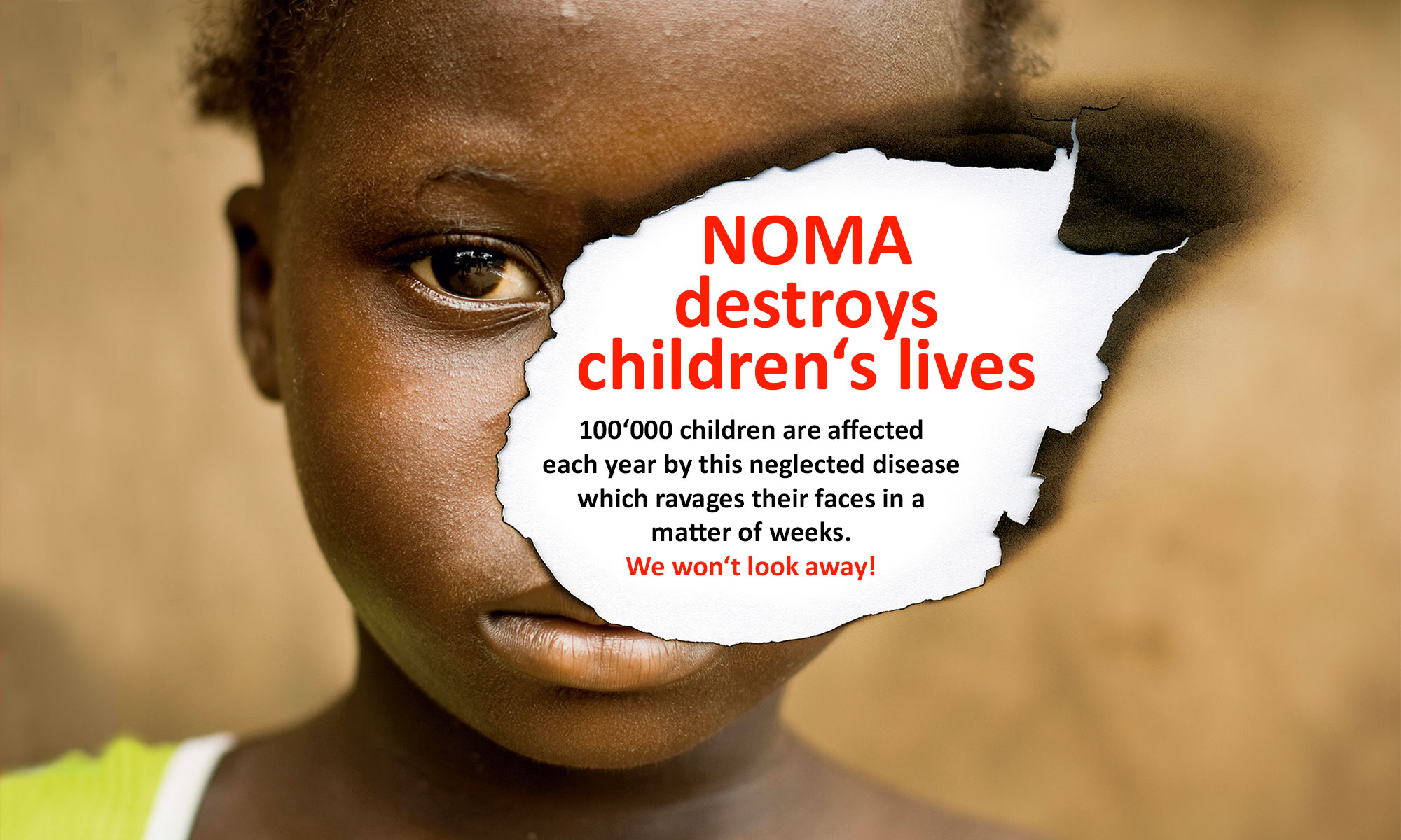 NOMA destroys children's lives.